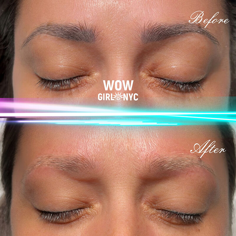 eyebrow tattoo removal before and after NYC