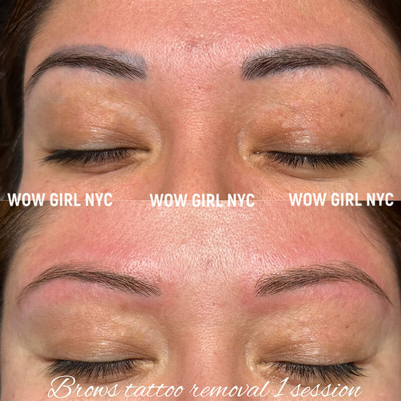 cosmetic eyebrow tattoo removal results NYC
