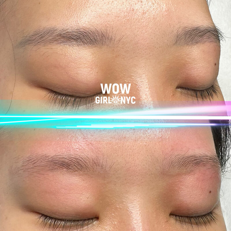 cosmetic eyebrow tattoo removal results NYC