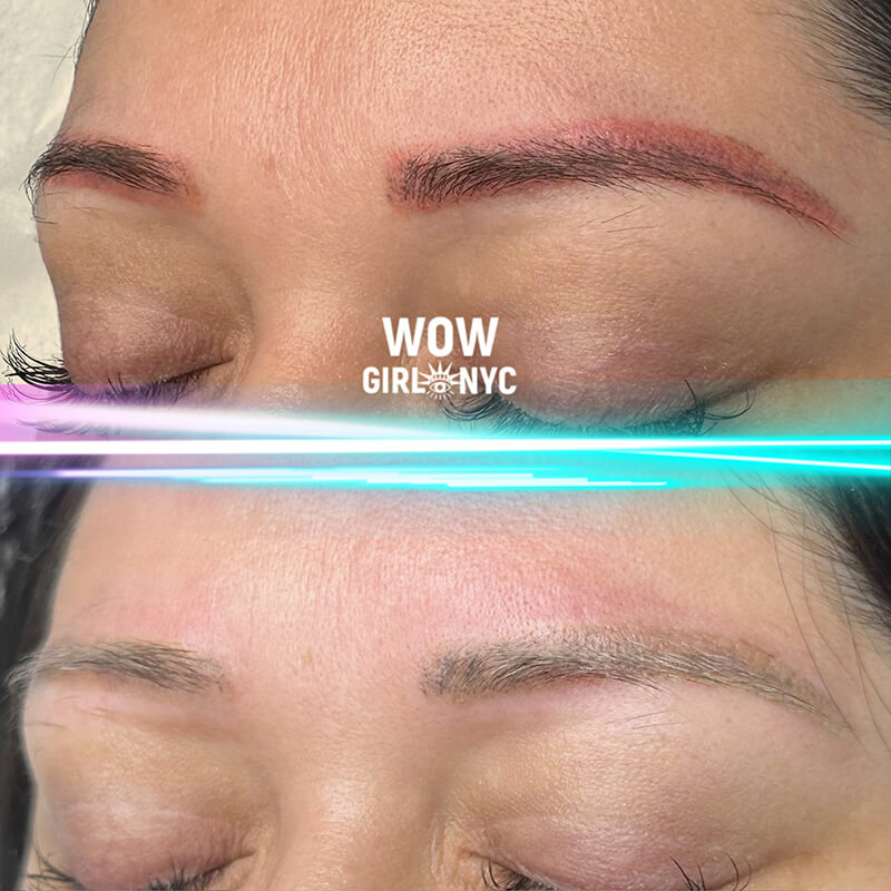 cosmetic eyebrow tattoo removal results NYC