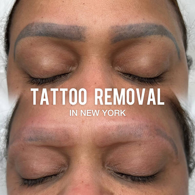 permanent eyebrow tattoo removal before after New York