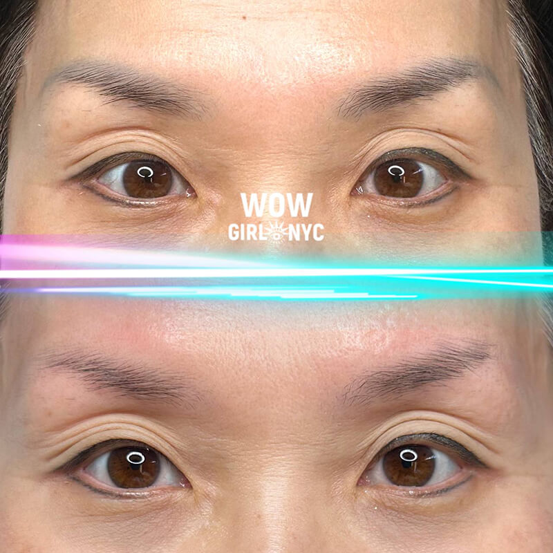 permanent eyebrow tattoo removal before after New York