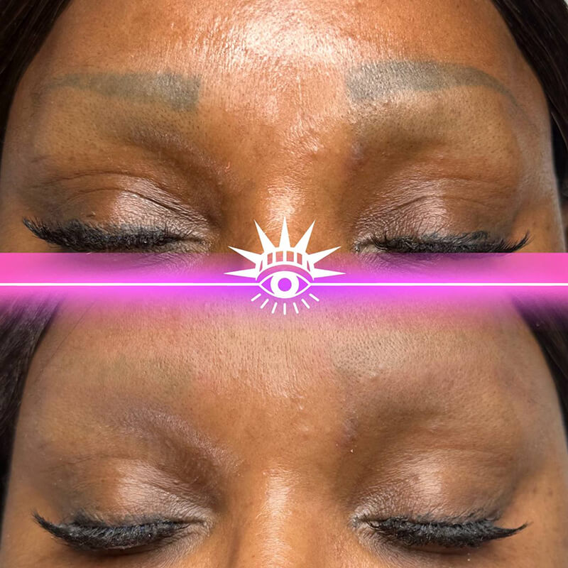permanent eyebrow tattoo removal before after New York