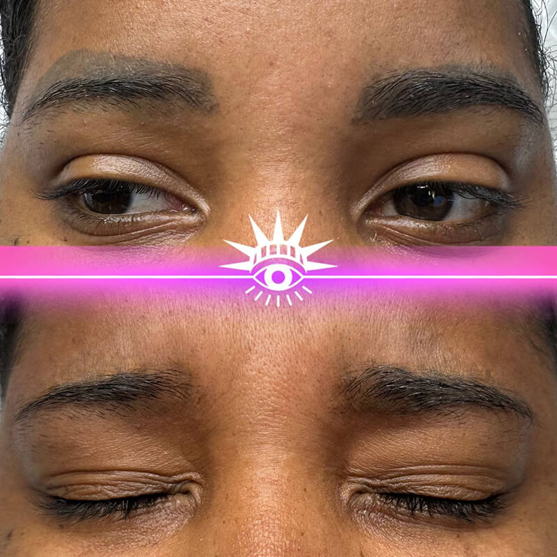 before and after laser eyebrow PMU removal NYC results