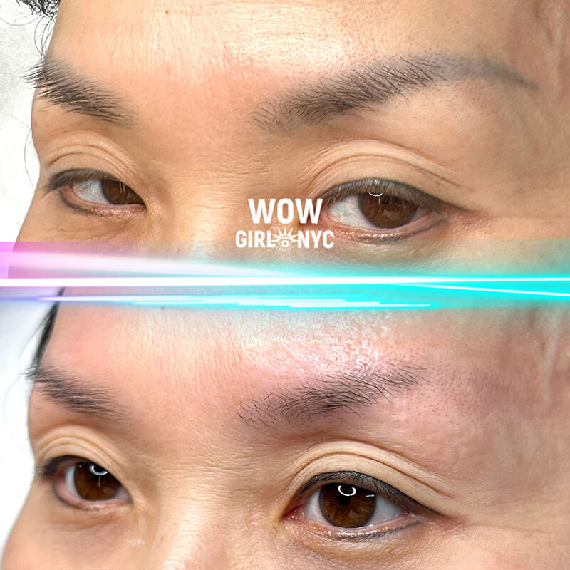 before and after laser eyebrow PMU removal NYC results