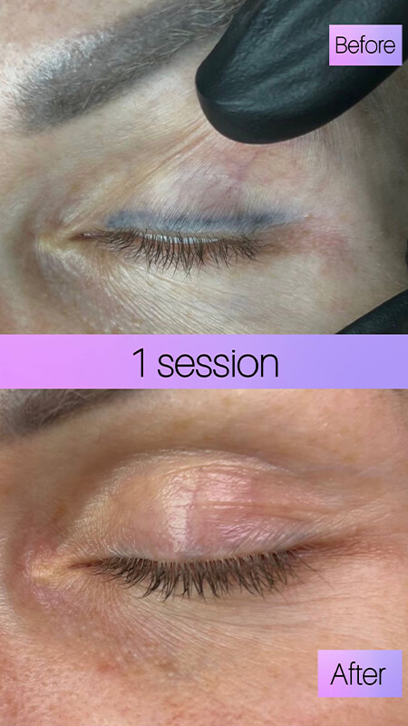 successful eyeliner tattoo removal before and after NYC