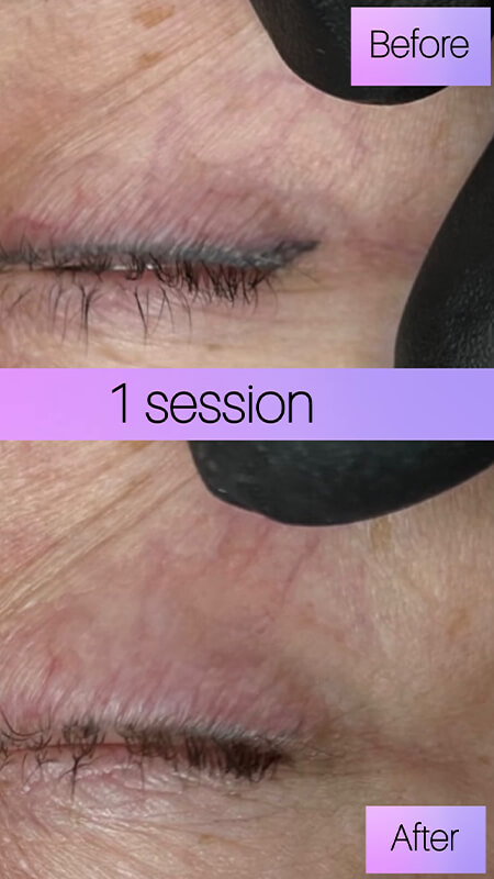 eyeliner tattoo removal before and after NYC