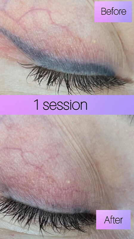 eyeliner tattoo removal before and after NYC