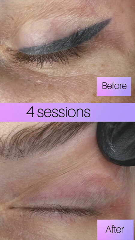 eyeliner tattoo removal before and after NYC