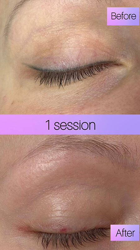 before and after laser eyeliner tattoo removal NYC results