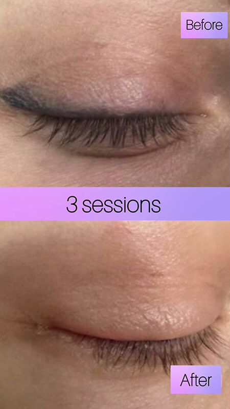 permanent eyeliner removal before after New York