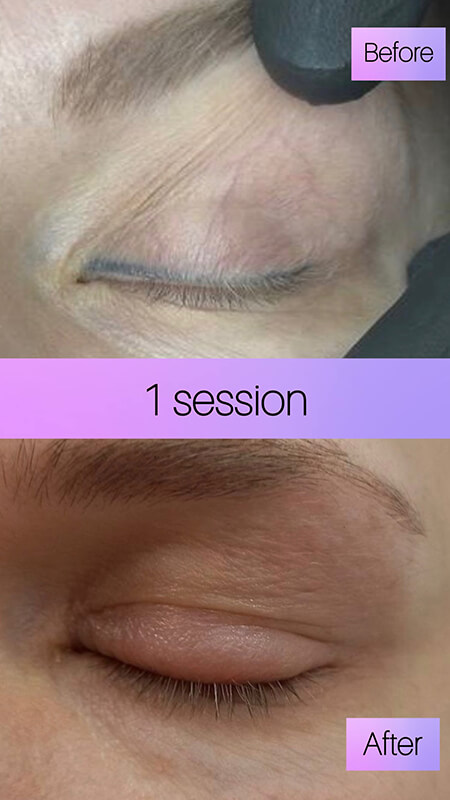 permanent eyeliner removal before after New York