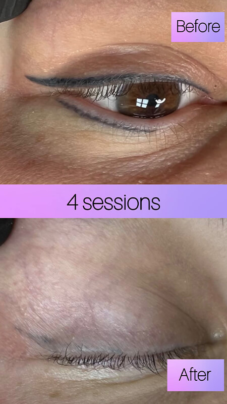 permanent eyeliner removal before after New York