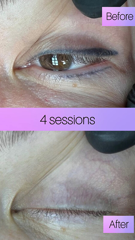 eyeliner tattoo removal before and after NYC