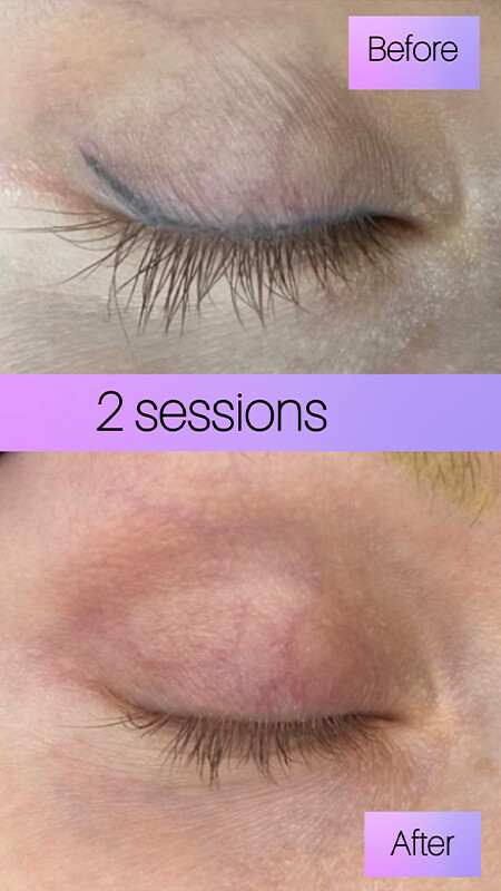 eyeliner tattoo removal before and after NYC