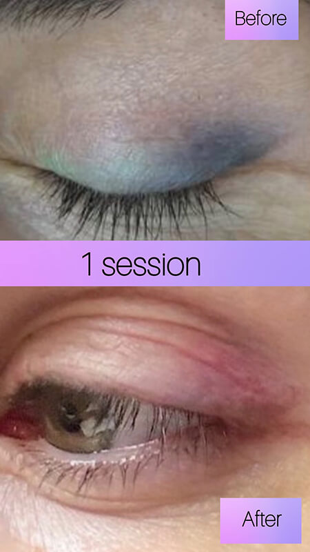 eyeliner tattoo removal before and after NYC