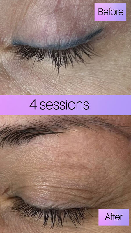 eyeliner tattoo removal before and after NYC