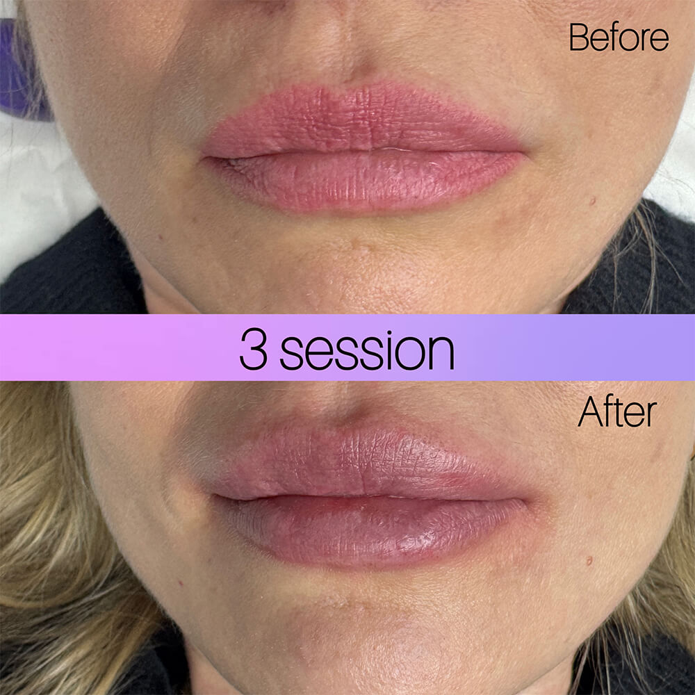 lip tattoo removal before and after NYC