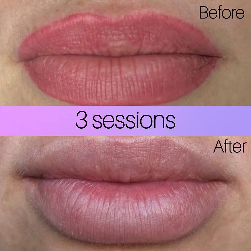 lip blush removal before after New York