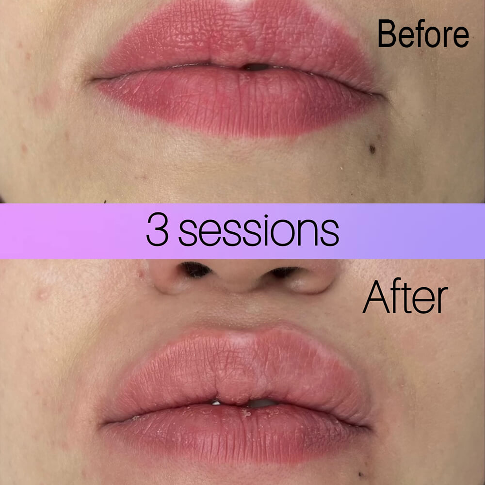 laser lip tattoo removal results NYC