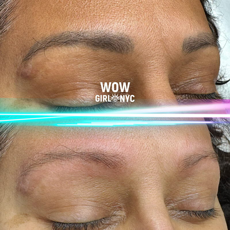 faded eyebrow PMU after laser removal New York