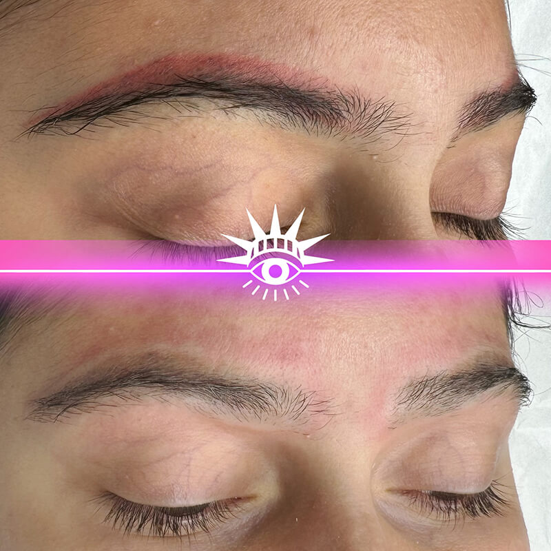 faded eyebrow PMU after laser removal New York