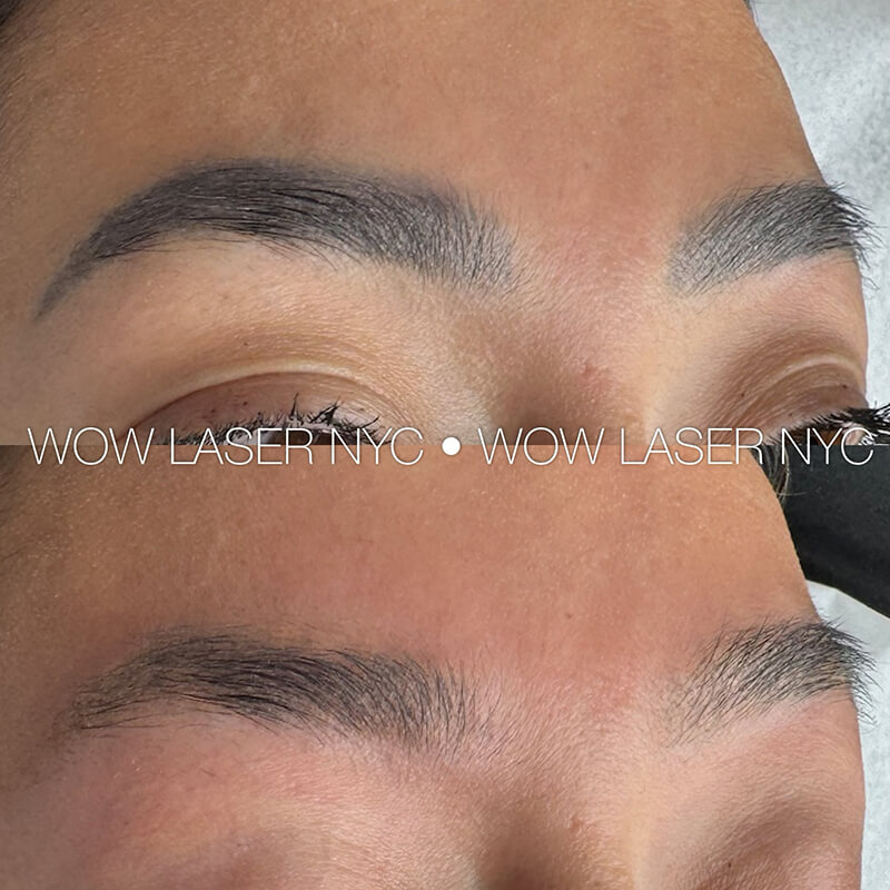 before after eyebrow PMU removal NYC