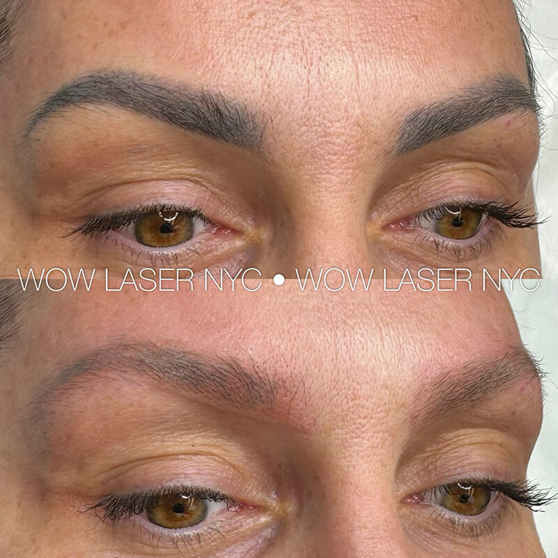 before after eyebrow PMU removal NYC