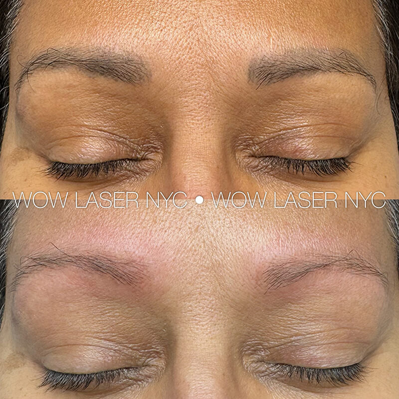 laser removal of permanent eyebrow makeup results New York