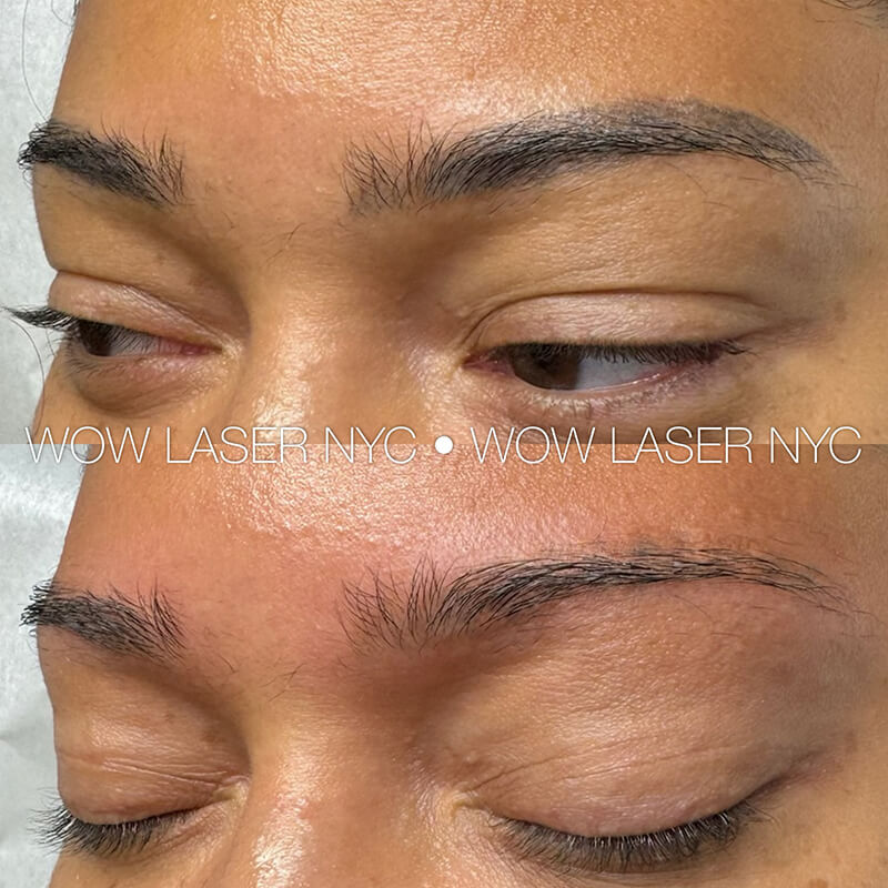laser removal of permanent eyebrow makeup results New York