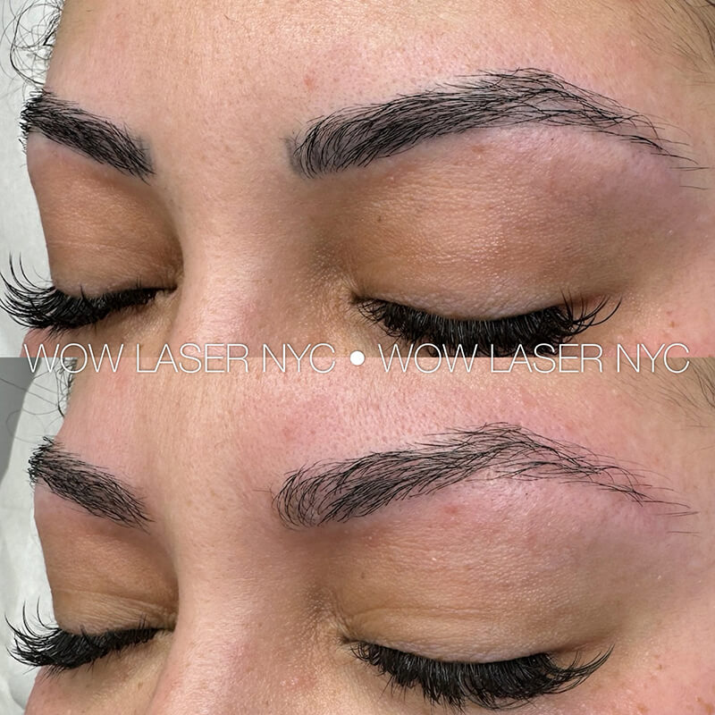 laser removal of permanent eyebrow makeup results New York