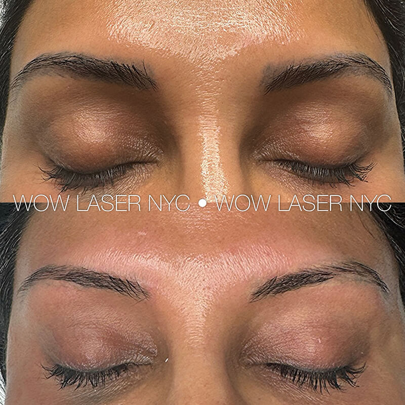 before after eyebrow PMU removal NYC