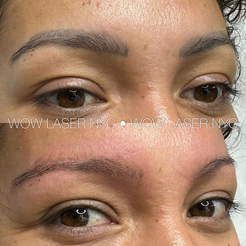 faded eyebrow PMU after laser removal New York