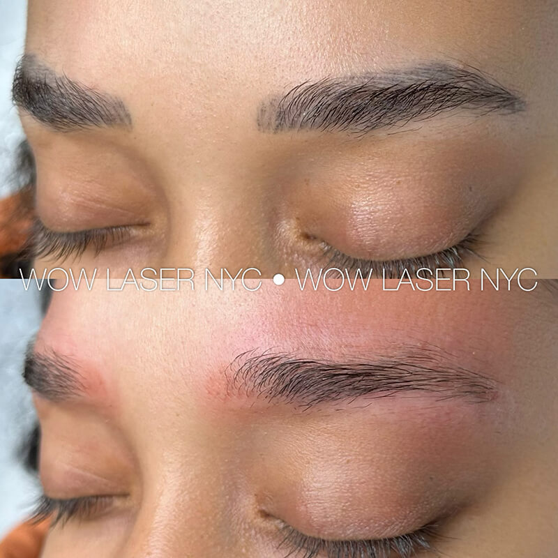 successful eyebrow tattoo removal before and after NYC