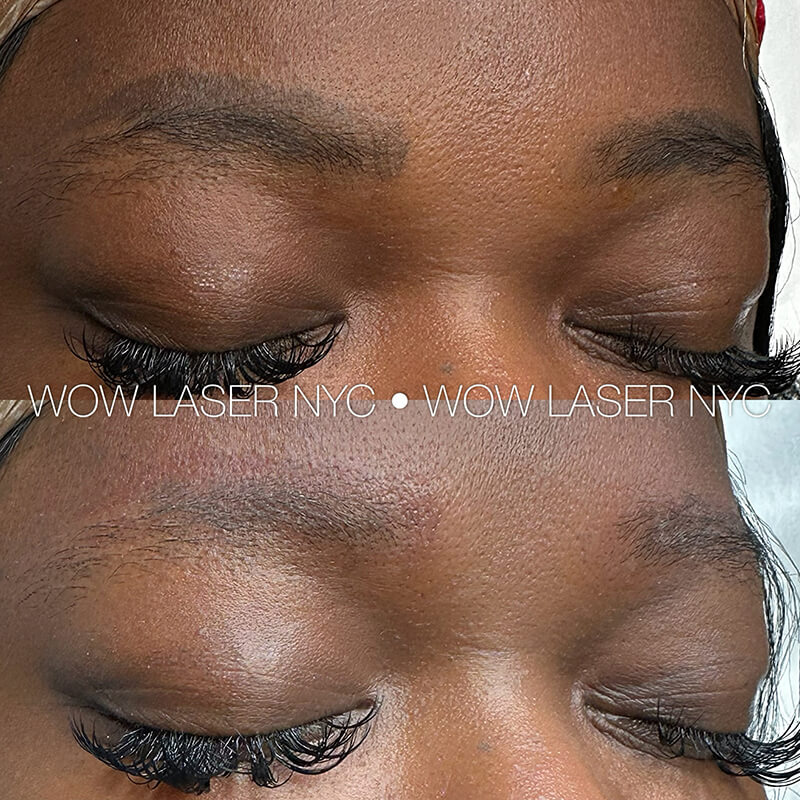 cosmetic eyebrow tattoo removal results NYC