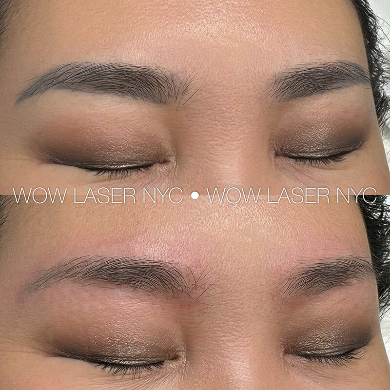 permanent eyebrow tattoo removal before after New York