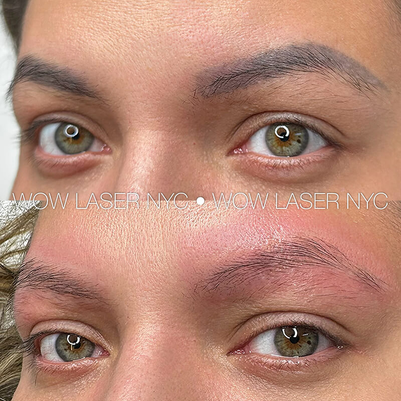 before and after laser eyebrow PMU removal NYC results