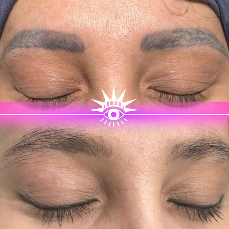 laser eyebrow tattoo removal results NYC