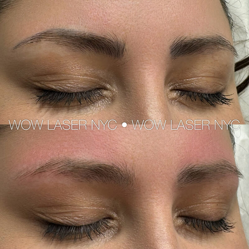 PMU eyebrow removal before after New York