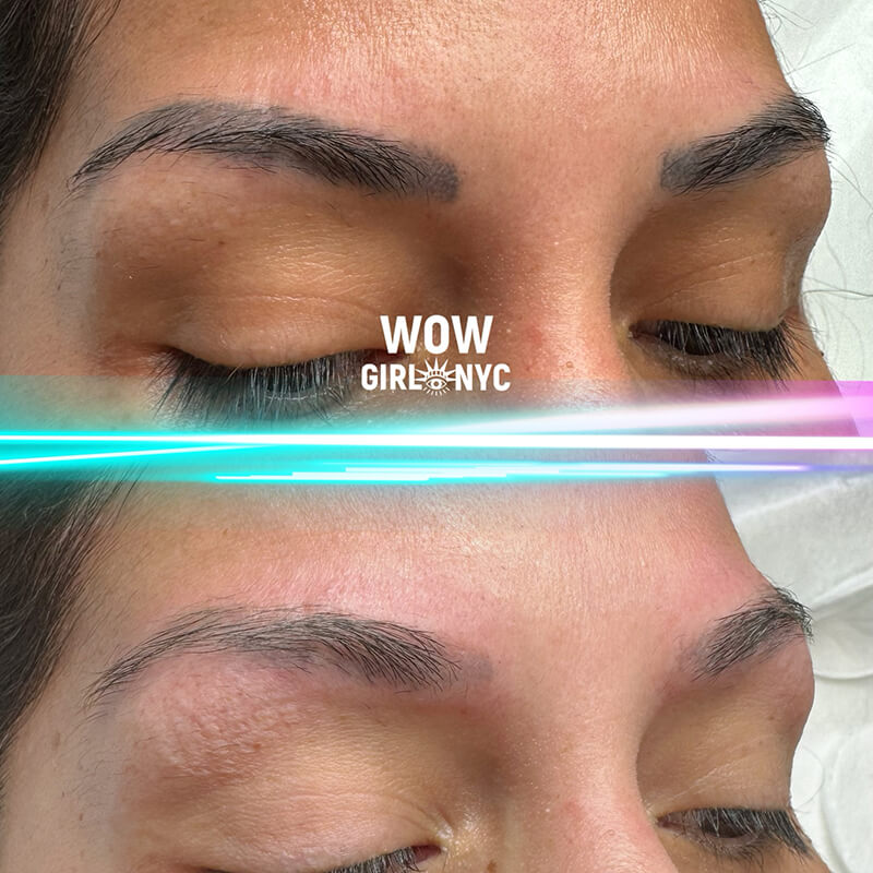 eyebrow tattoo removal before and after NYC