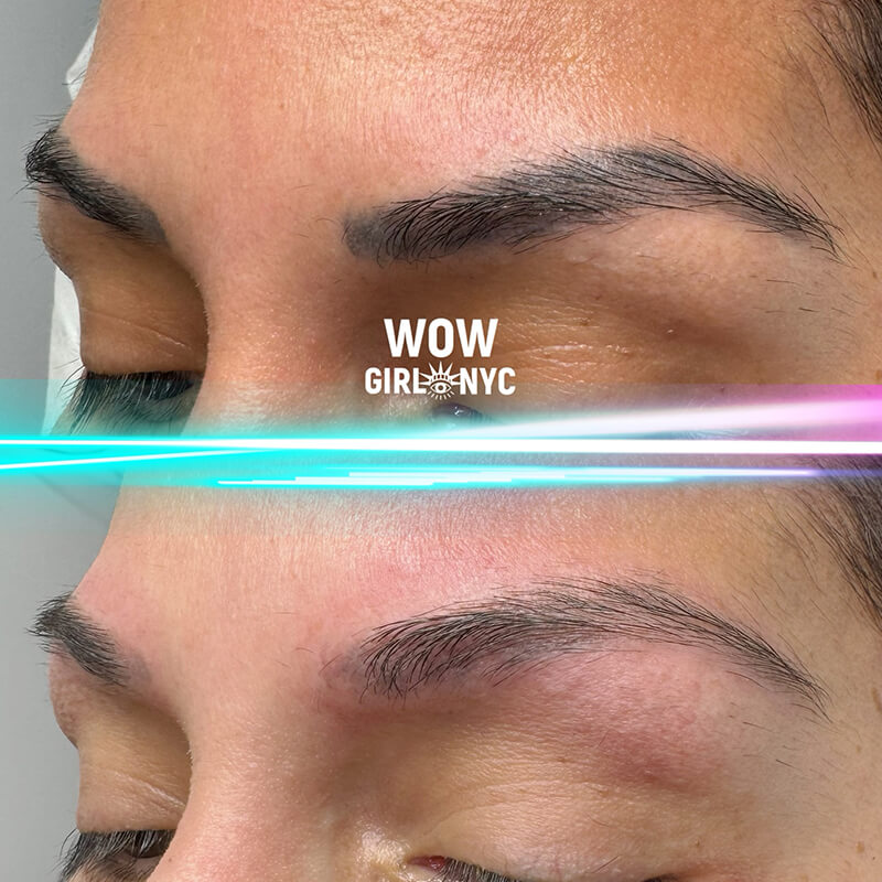 PMU eyebrow removal before after New York