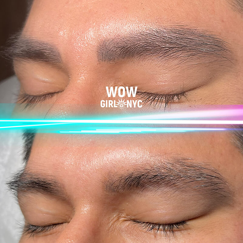 eyebrow tattoo removal before and after NYC
