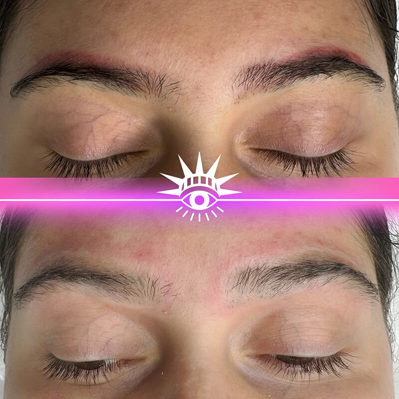 eyebrow tattoo removal before and after NYC
