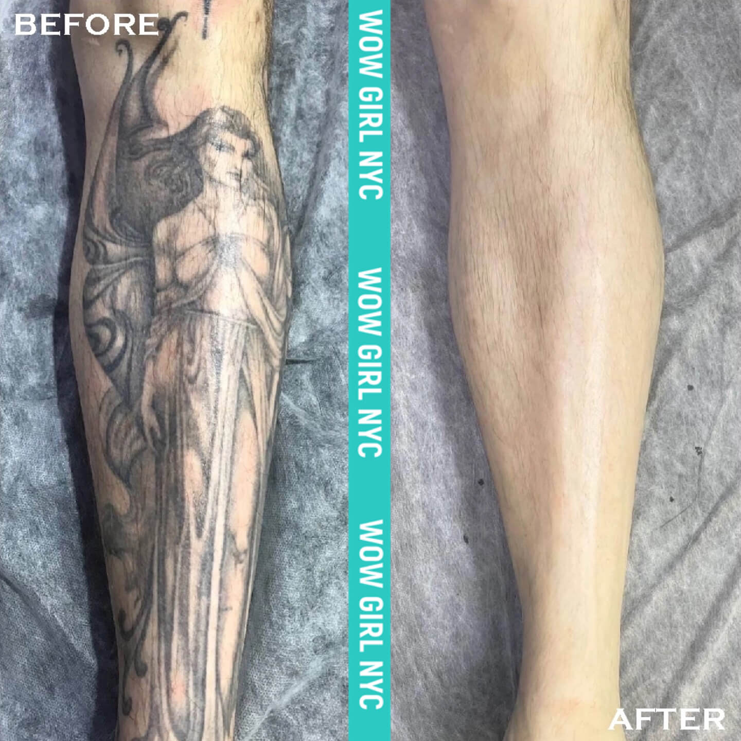 tattoo removal before after New York