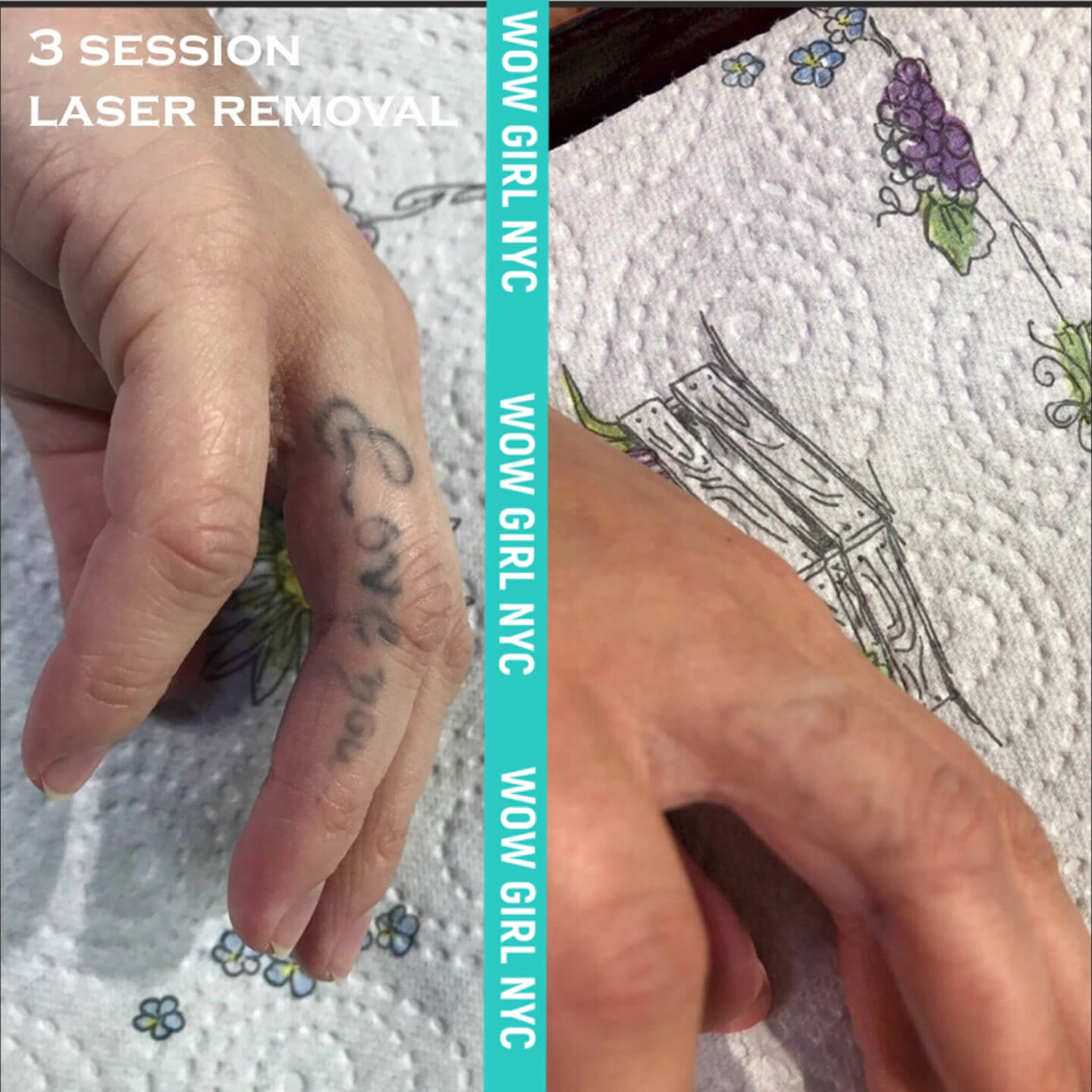 laser removal of arm tattoo results New York