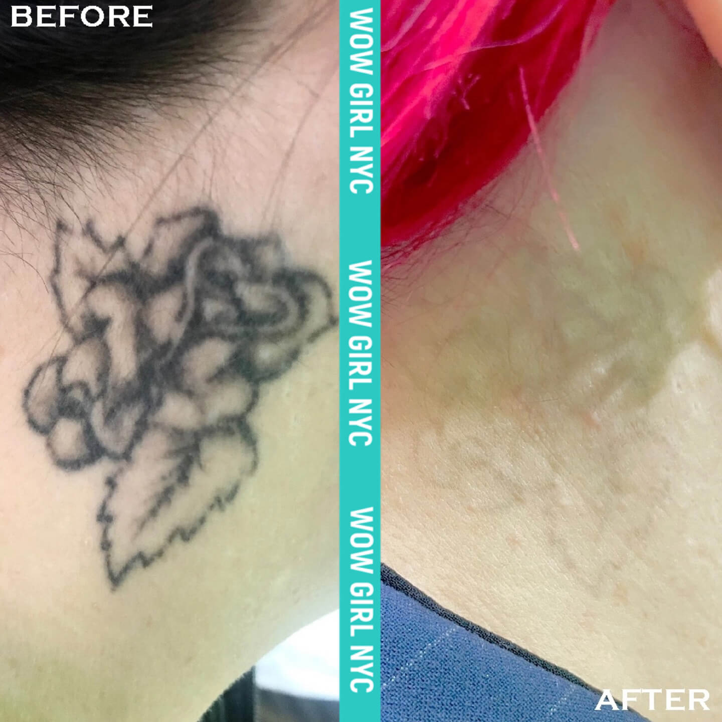 laser removal of arm tattoo results New York