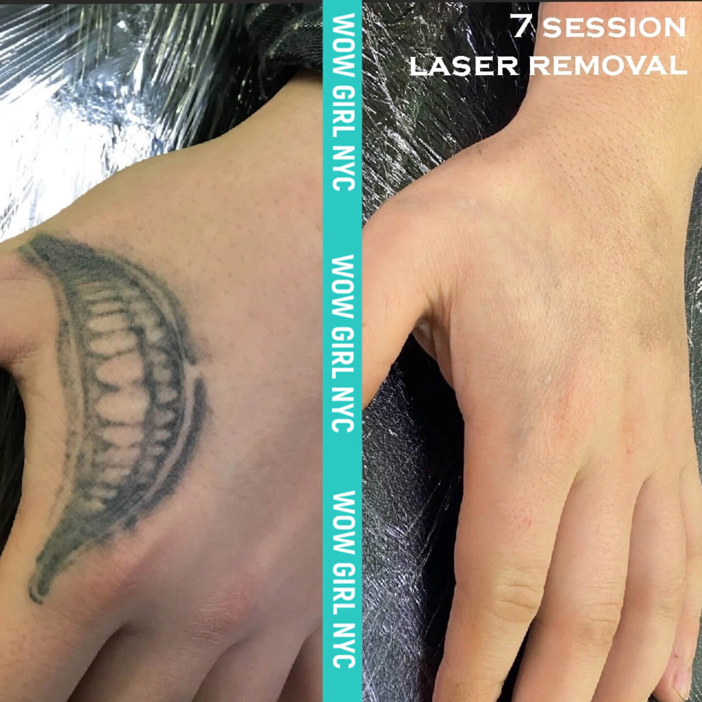 laser removal of arm tattoo results New York