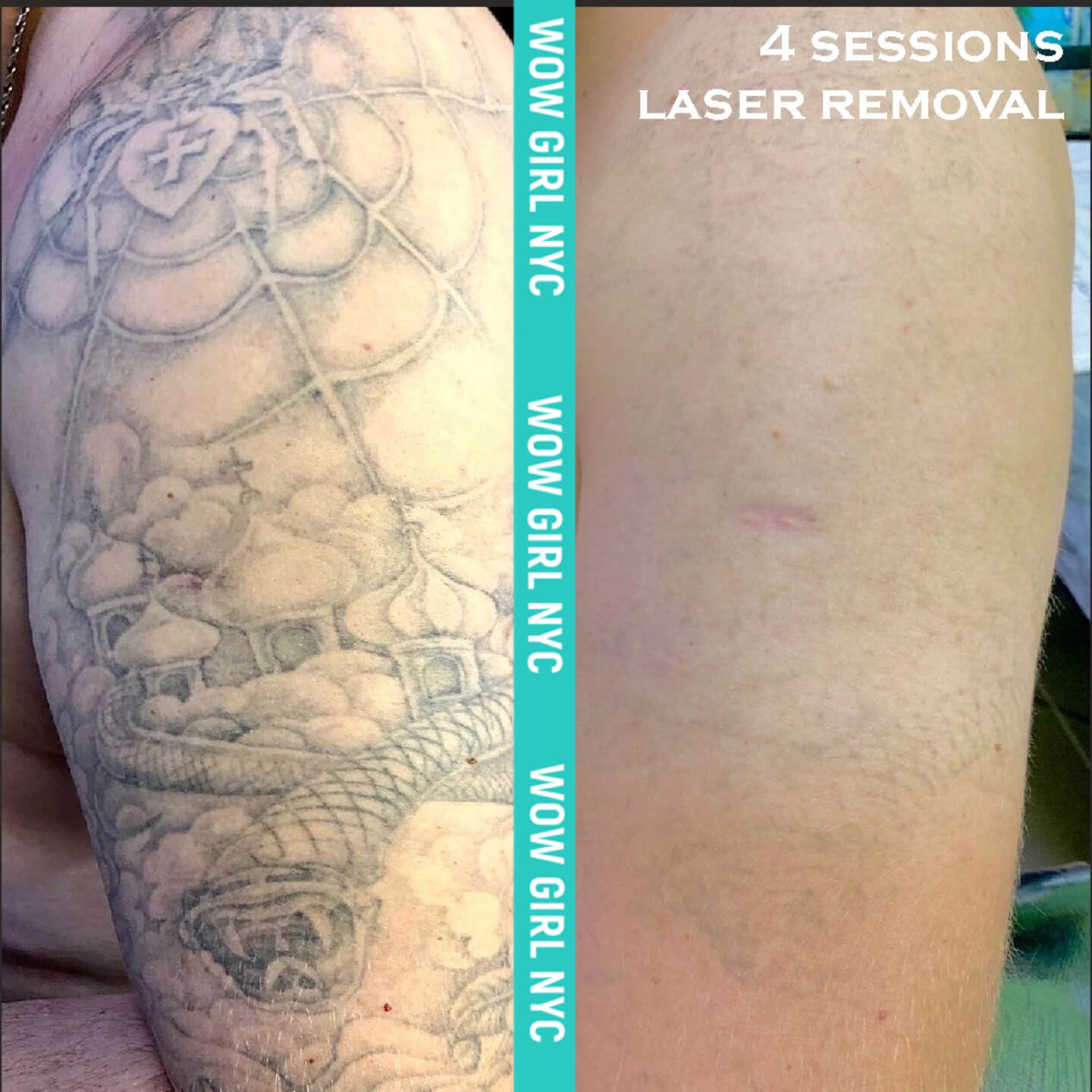laser removal of arm tattoo results New York