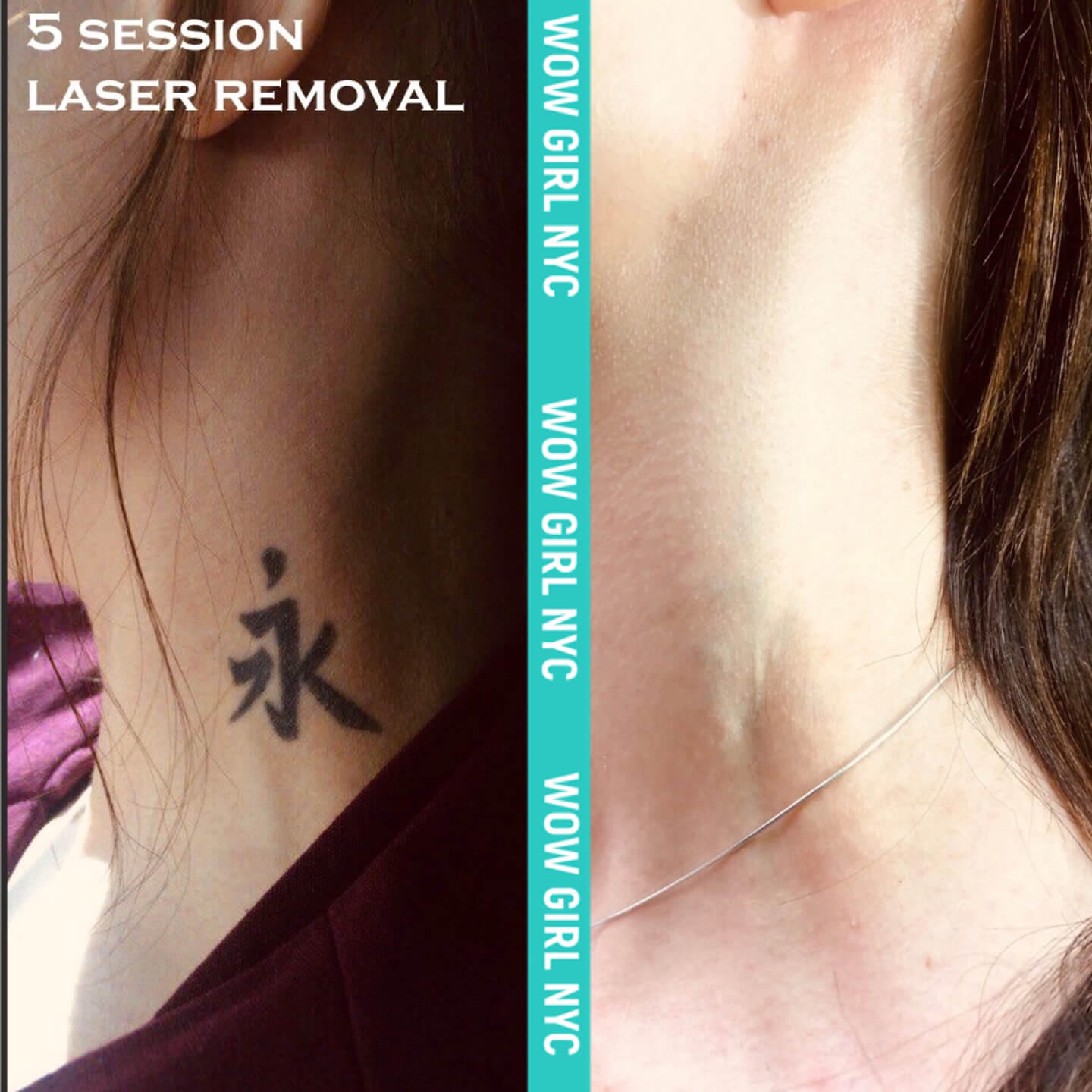 laser removal of arm tattoo results New York