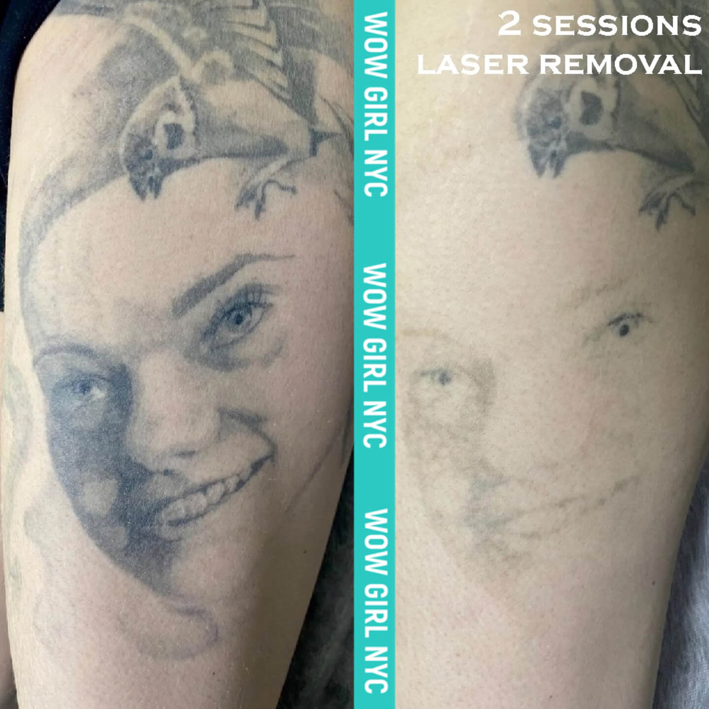 laser removal of arm tattoo results New York